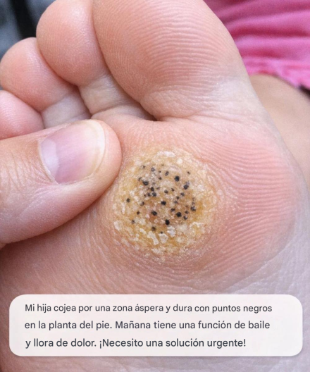 Mi hija cojea por una zona áspera y dura con puntos negros en la planta del pie. Mañana tiene una función de baile y llora de dolor. ¡Necesito una solución urgente!