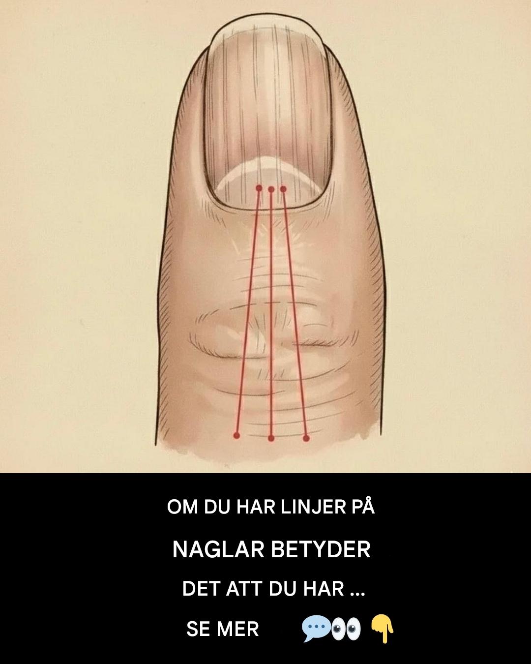 Linjer på dina naglar: Vad de kan avslöja om din hälsa