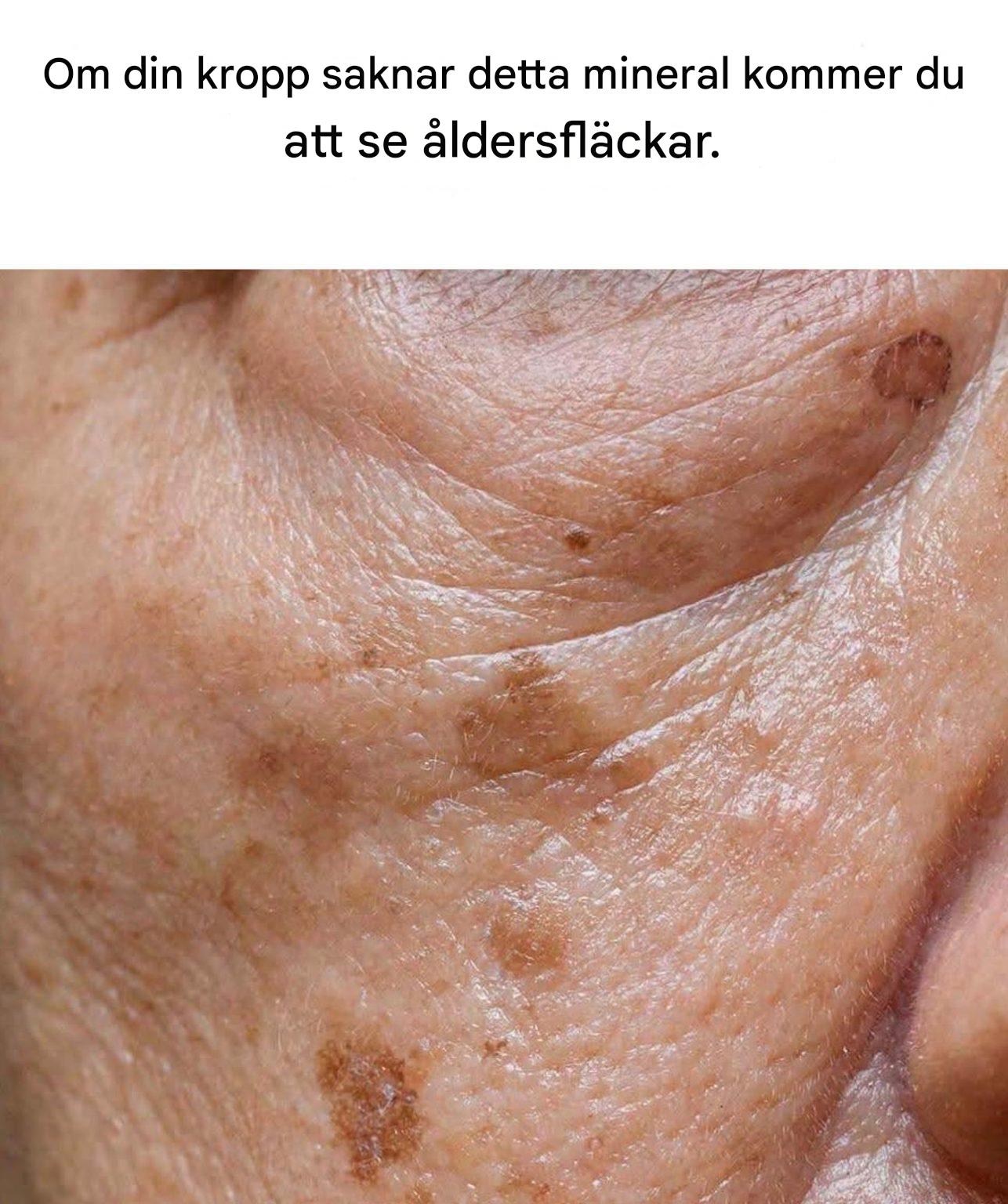 Brist på detta mineral ökar risken för åldersfläckar.