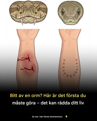 Blev du biten av en orm? Det första du måste göra – det kan rädda ditt liv.