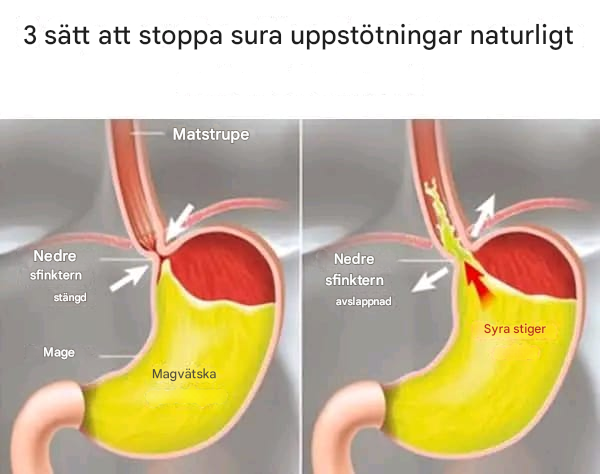 3 sätt att stoppa sura uppstötningar naturligt – se kommentaren…